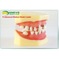 EN-L4 Peridontal Disease Dental Model with Removable Soft Gingival